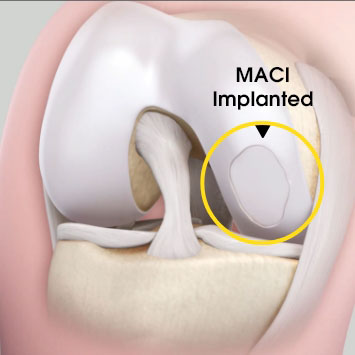 MACI implanted