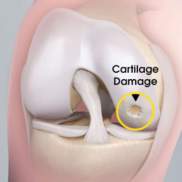 Cartilage damage