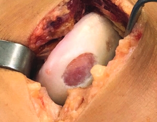 Condyle cartilage debridement