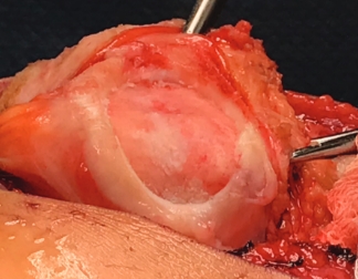 Condyle cartilage debridement