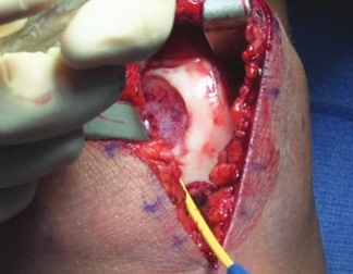 Trochlea Debridement