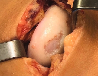 Condyle Defect