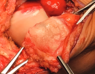 Patella Defect