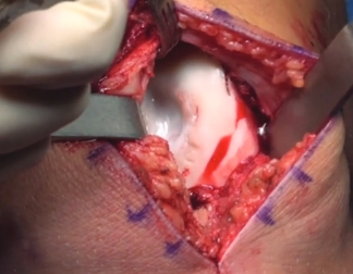 Trochlea cartilage defect