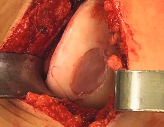 Condyle MACI implantation