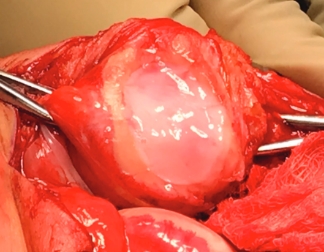 Patella Implantation