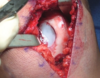 Trochlea Implantation