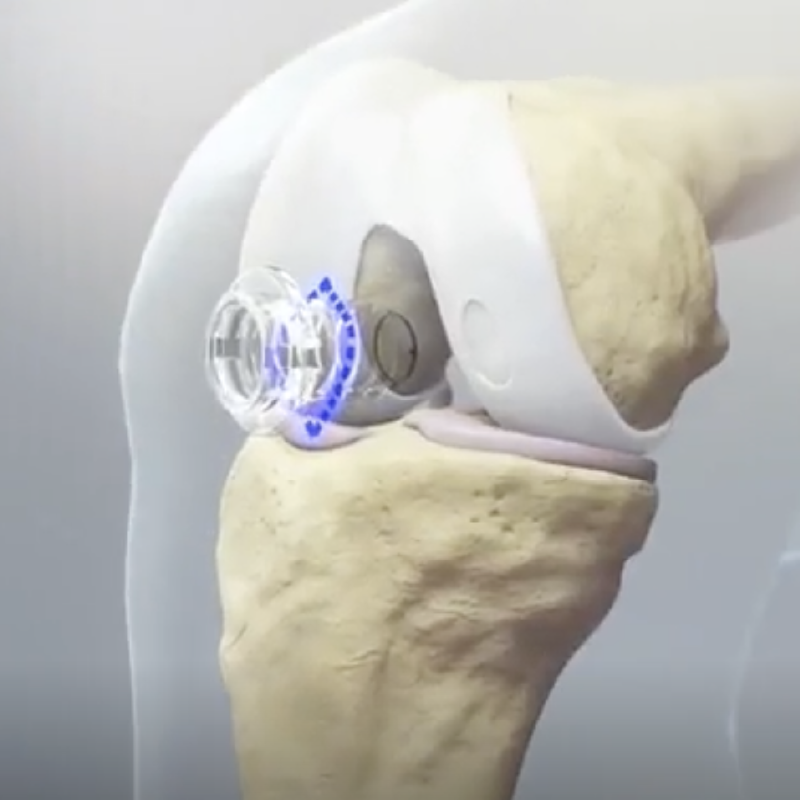 Media Resources - MACI Arthro Patient & HCP Animations