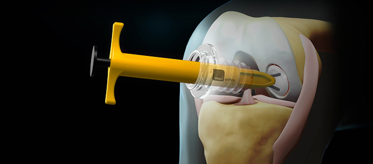 Arthroscopy