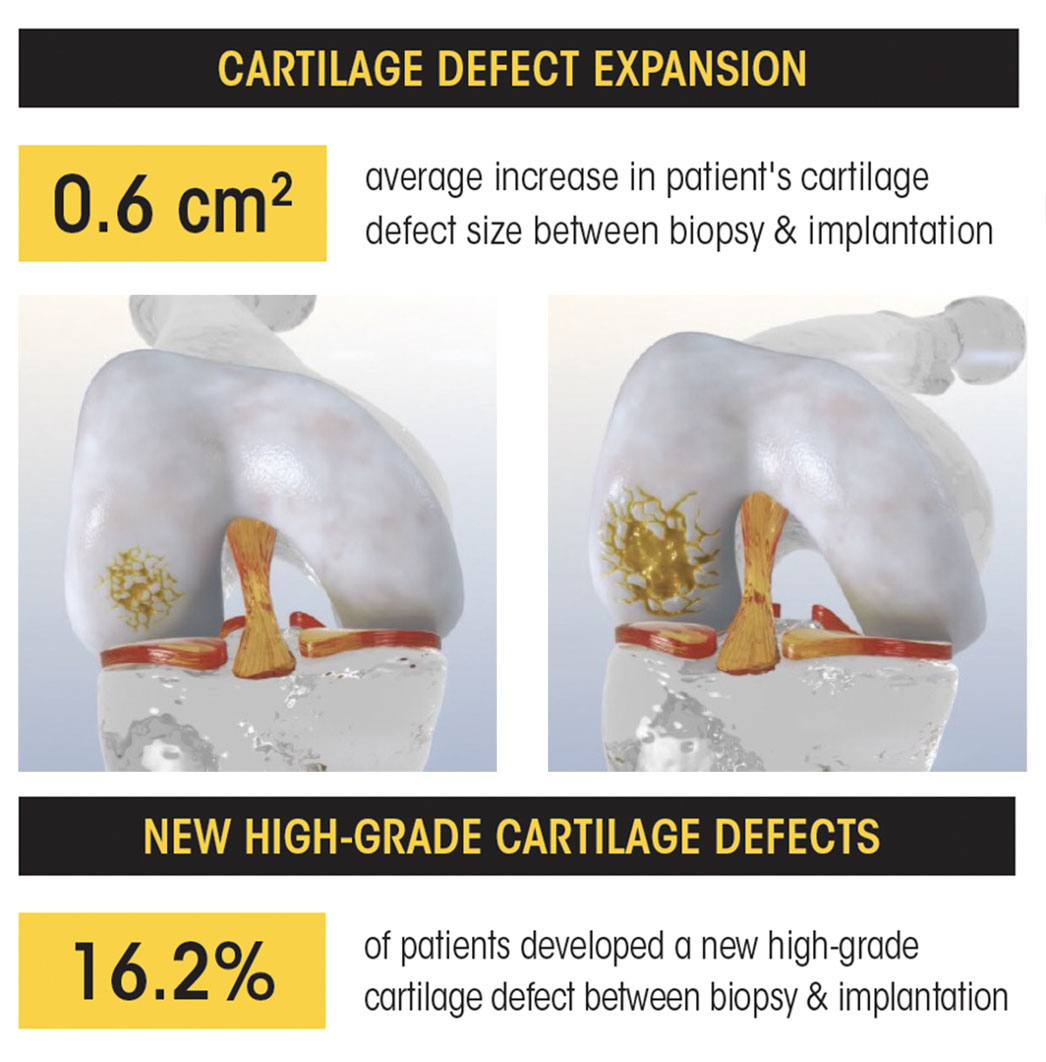 An example of a knee cartilage lesion growing in size. Text explains that the “Time Matters” study found that cartilage defect expansions grew an average of 0.6cm2 between biopsy and implantation. New high-grade defects formed in 16.2 percent of patients.