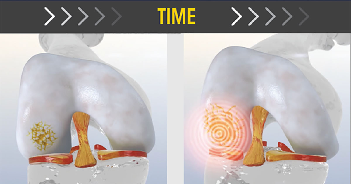 Time Matters: Why You Shouldn't Wait to Treat Your Cartilage Injury