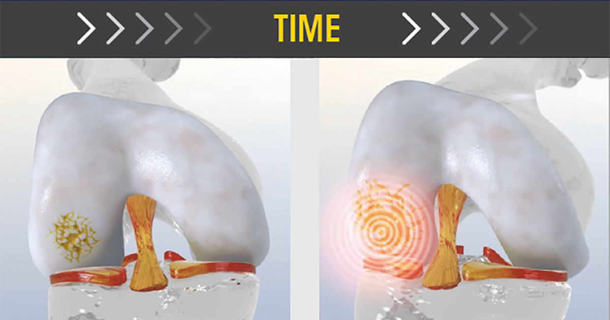 Time Matters: Why it's Important to Avoid Delays Between Biopsy and Knee Cartilage Repair Surgery