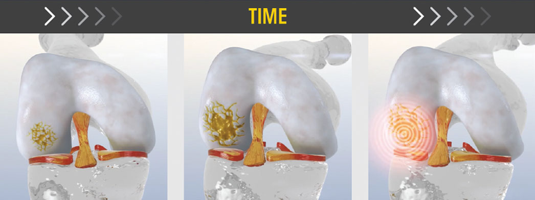 Image of a knee cartilage lesion as it gets larger over time