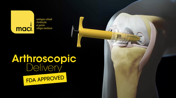 MACI Arthro Instrumentation: An Exciting Development in Arthroscopic Knee Cartilage Repair