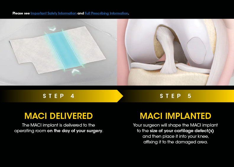 Step 4 & 5: MACI is Delivered & Then Implanted