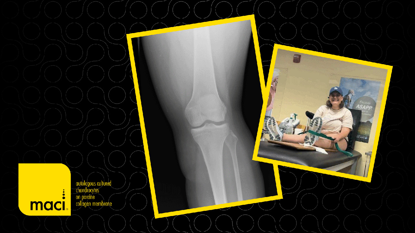 MACI Arthro Case: Exploring MACI Knee Cartilage Repair via Arthroscopic Delivery