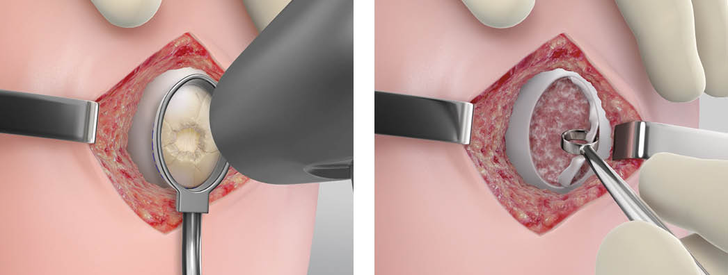 Preparation of the Defect