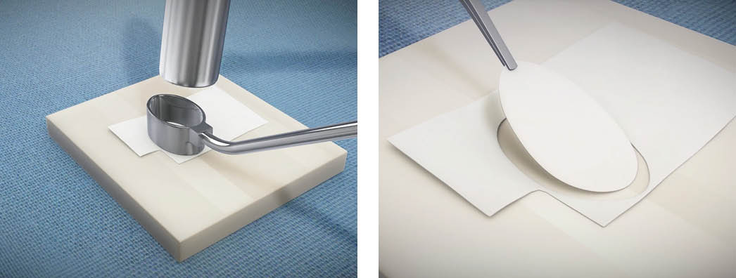 Shaping the MACI Implant
