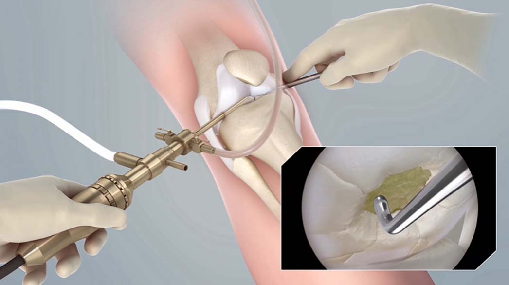 Arthroscopy for knee cartilage damage