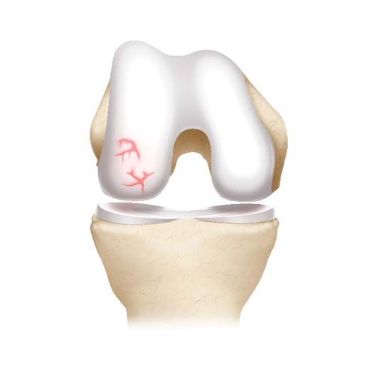 Knee cartilage defect.