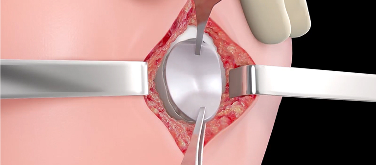 Mini Arthrotomy