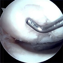 Lateral femoral condyle (LFC) image 1