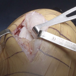 Lateral femoral condyle (LFC) image 2