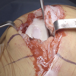 Lateral femoral condyle (LFC) image 4