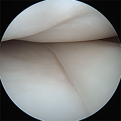 Medial femoral condyle (MFC) image 1