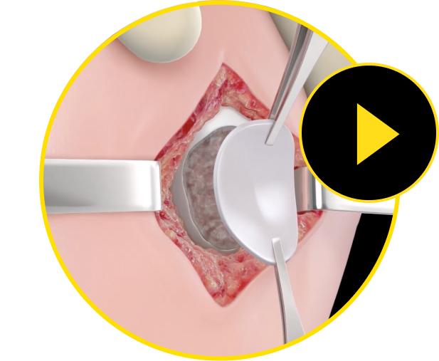 Mini-arthrotomy