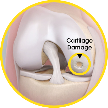 Cartilage damage