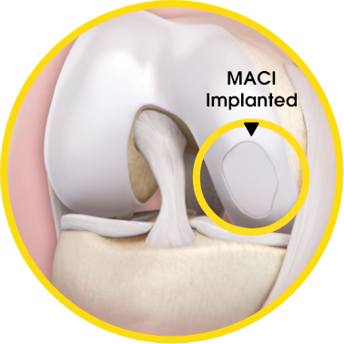 MACI Implanted 