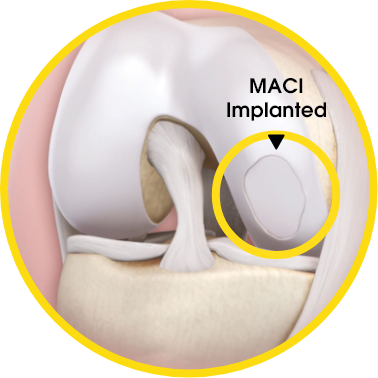 MACI Implanted