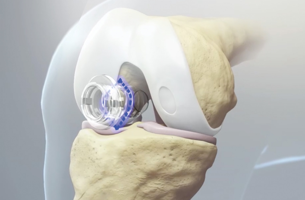 Arthroscopic Delivery