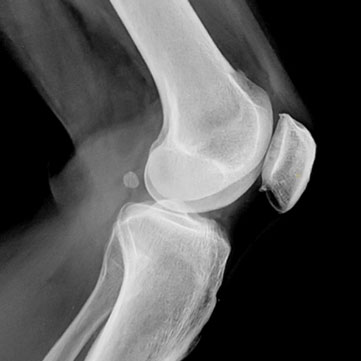 Knee x-ray